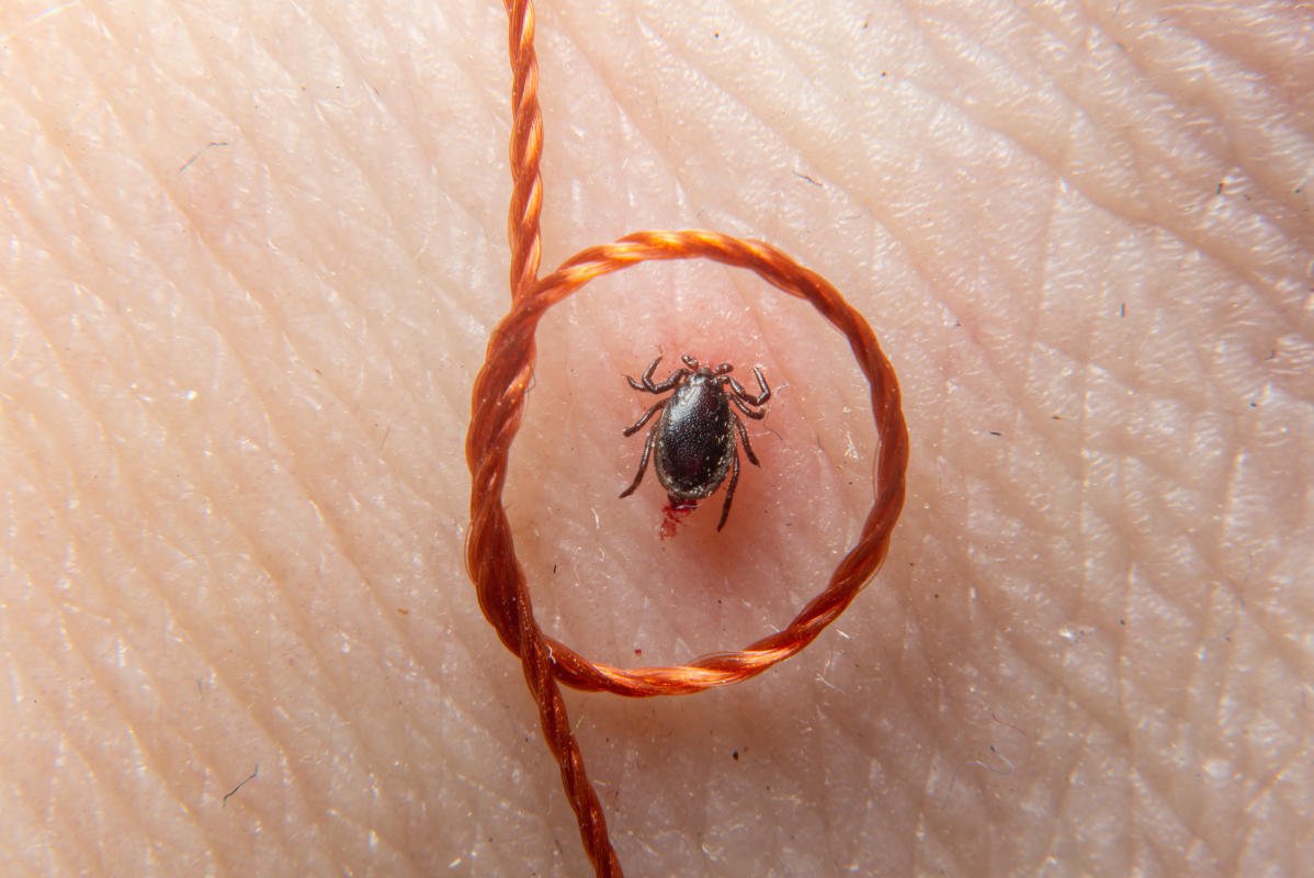 Maladie de Lyme - Tique - Nœud coulant ouvert